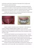 Imagine document Implanturile subperiostale complete mandibulare