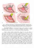Imagine document Îngrijirea stomelor - gastrostomia
