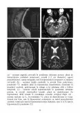 Imagine document Studiul sclerozei multiple și a valvulopatiilor colagenozice folosind imagistică prin rezonanță