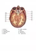Imagine document Studiu de caz privind leziunile nervoase în traumatismele cranio - cerebrale
