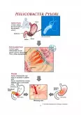 Imagine document Secreția gastrică - afecțiuni ale stomacului