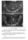 Imagine document Reabilitarea orală cu ajutorul protezelor parțiale amovibile în cazul edentățiilor întinse