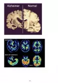 Imagine document Îngrijirea bolnavului cu Alzheimer în geriatrie